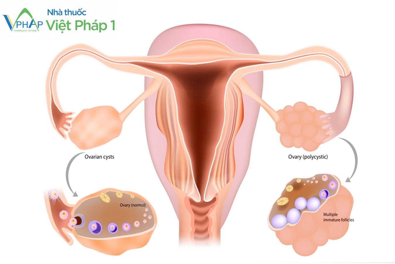 Bệnh đa nang buồng trứng ở phụ nữ 
