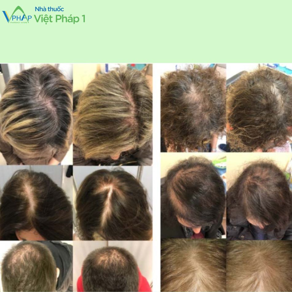 Hình ảnh: Trước và sau khi sử dụng xịt tóc Redenyl 