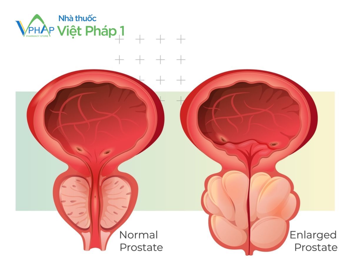 Viên uống hỗ trợ điều trị phì đại tuyến tiền liệt
