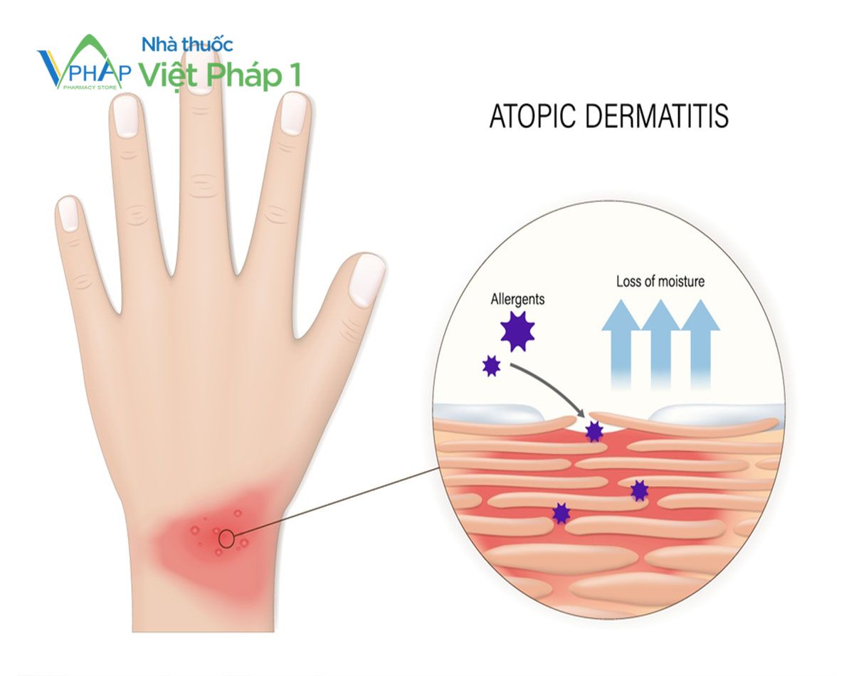 Da bị vi khuẩn tấn công